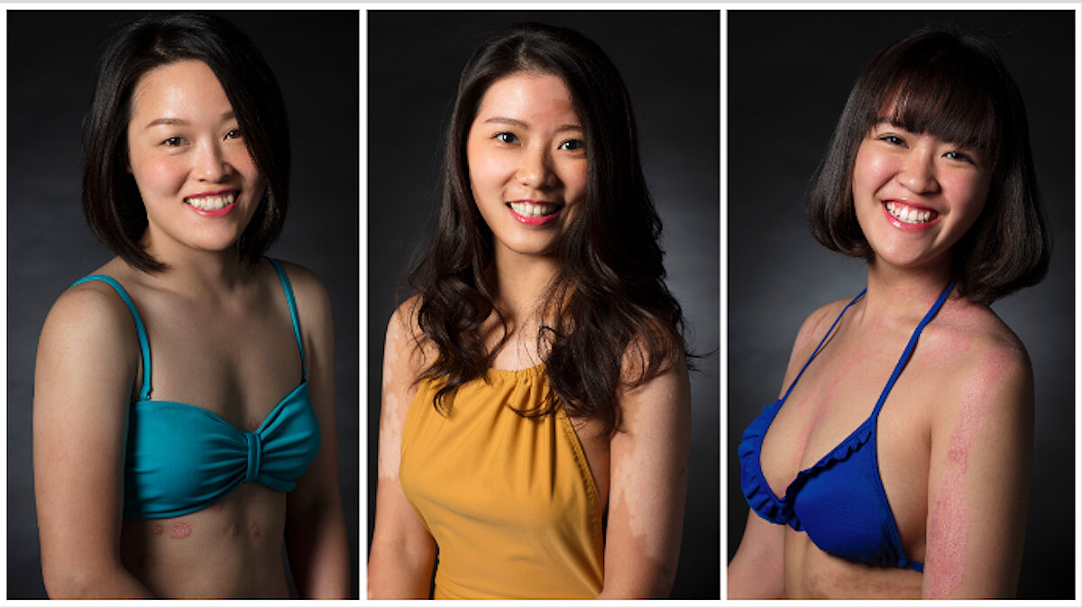 終於不用遮遮掩掩！穿上泳衣，乾癬患者的無懼宣言