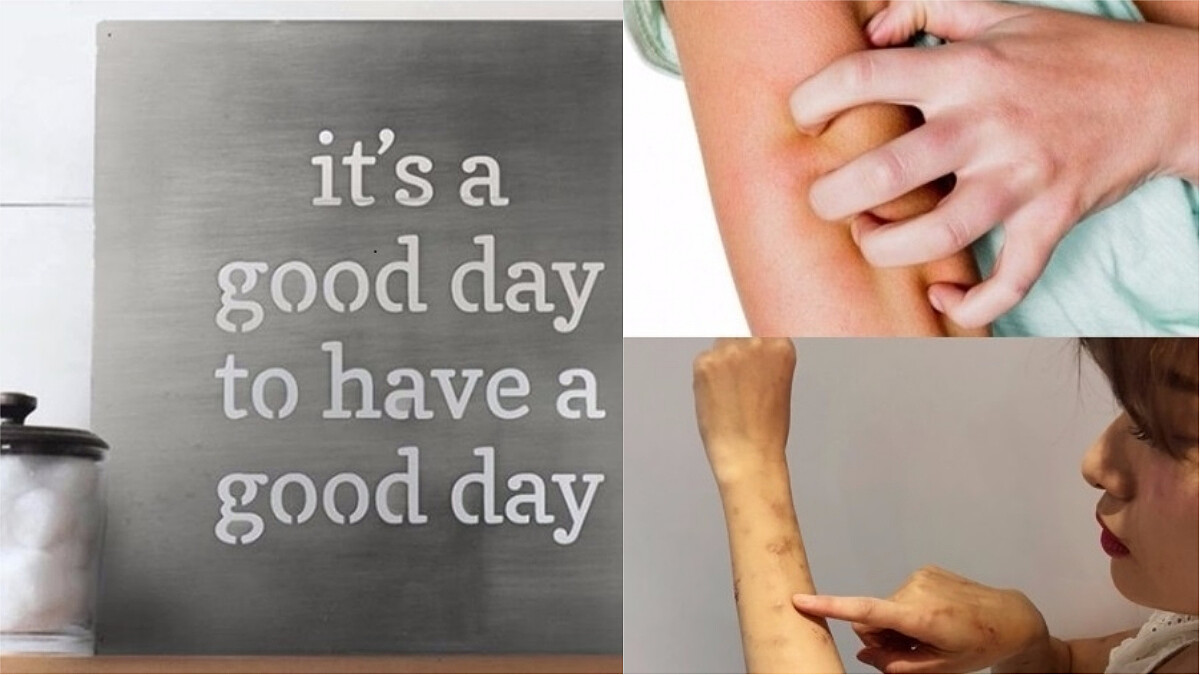 與蕁麻疹同行〜妳可以這麼做！M編跟大家站在同陣線努力ing，讓我們一起揮別癢癢人！