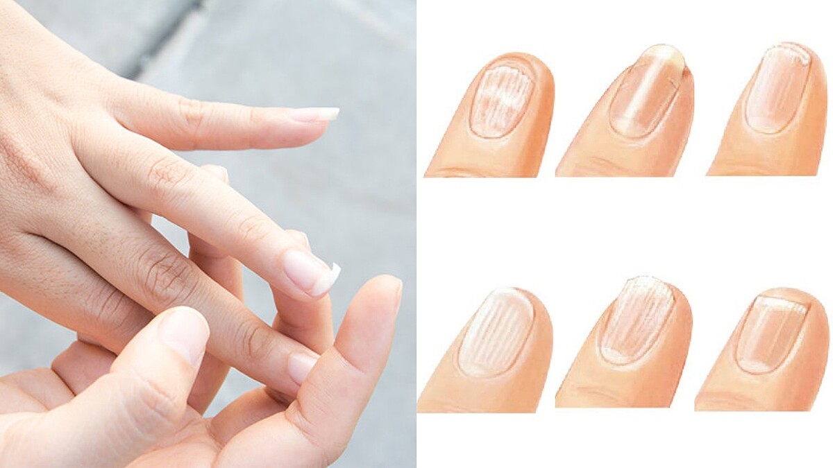 你的指甲健康嗎？原來指甲有受損、乾燥、易碎、剝落、軟薄、紋路這6大甲面問題，超簡易看圖判斷你是否也在其中