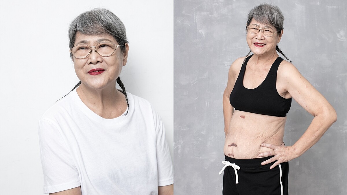 疤痕是好朋友！張智美：「人真的要快樂，不能憂傷，身體才會健康。」