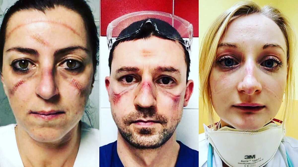 向全球第一線醫護人員致敬!拿掉口罩、護具後臉上的壓痕讓人心疼,是最美麗的抗疫印記
