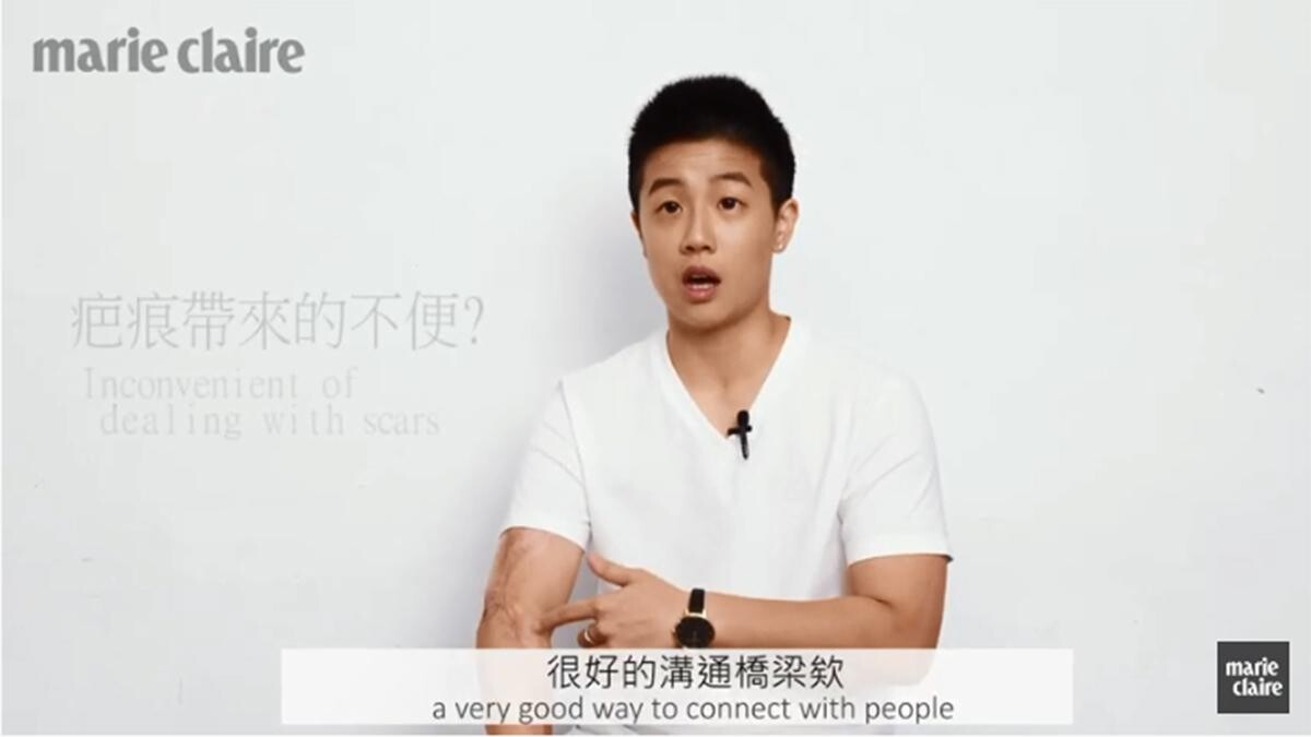疤痕讓我獨一無二！周旻琦，「活到30歲，終於開始喜歡我的身體。」Behind The Scars-Mickey Chou
