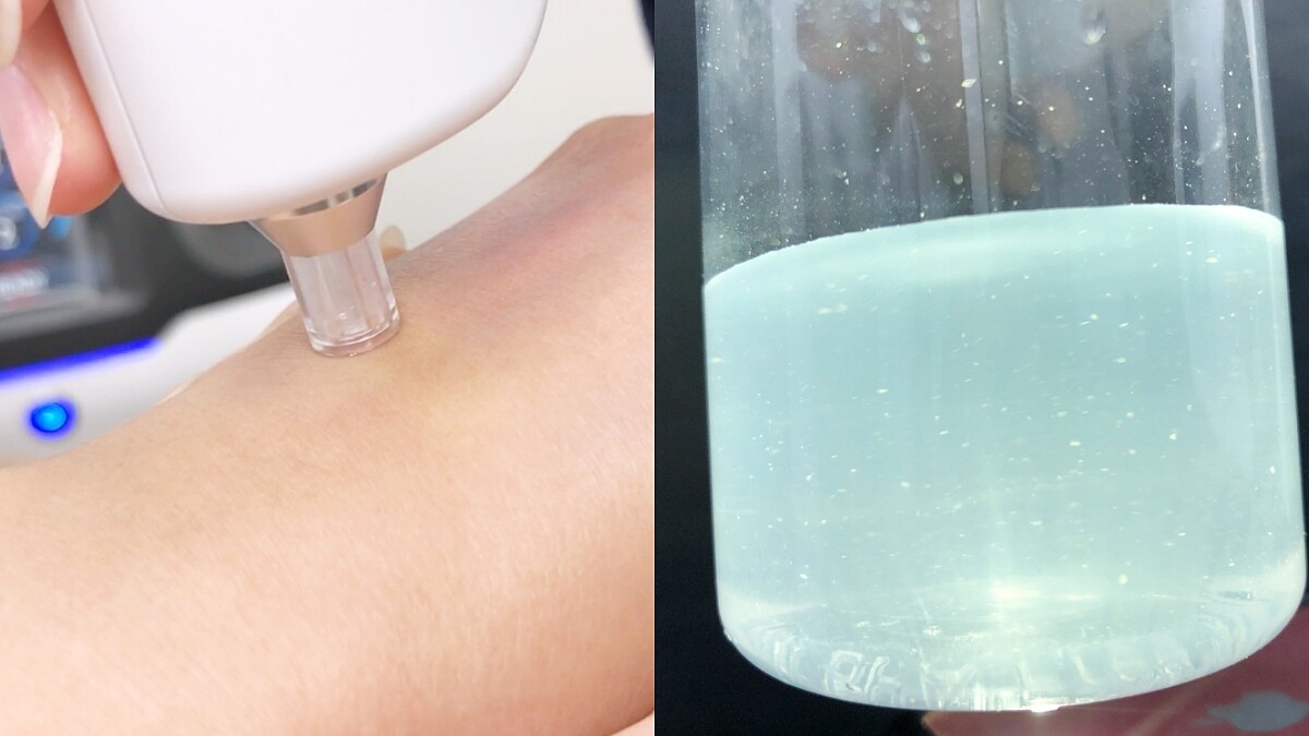 夏天詢問度最高的醫美就是「水飛梭」，大家最想知道的QA一次解答