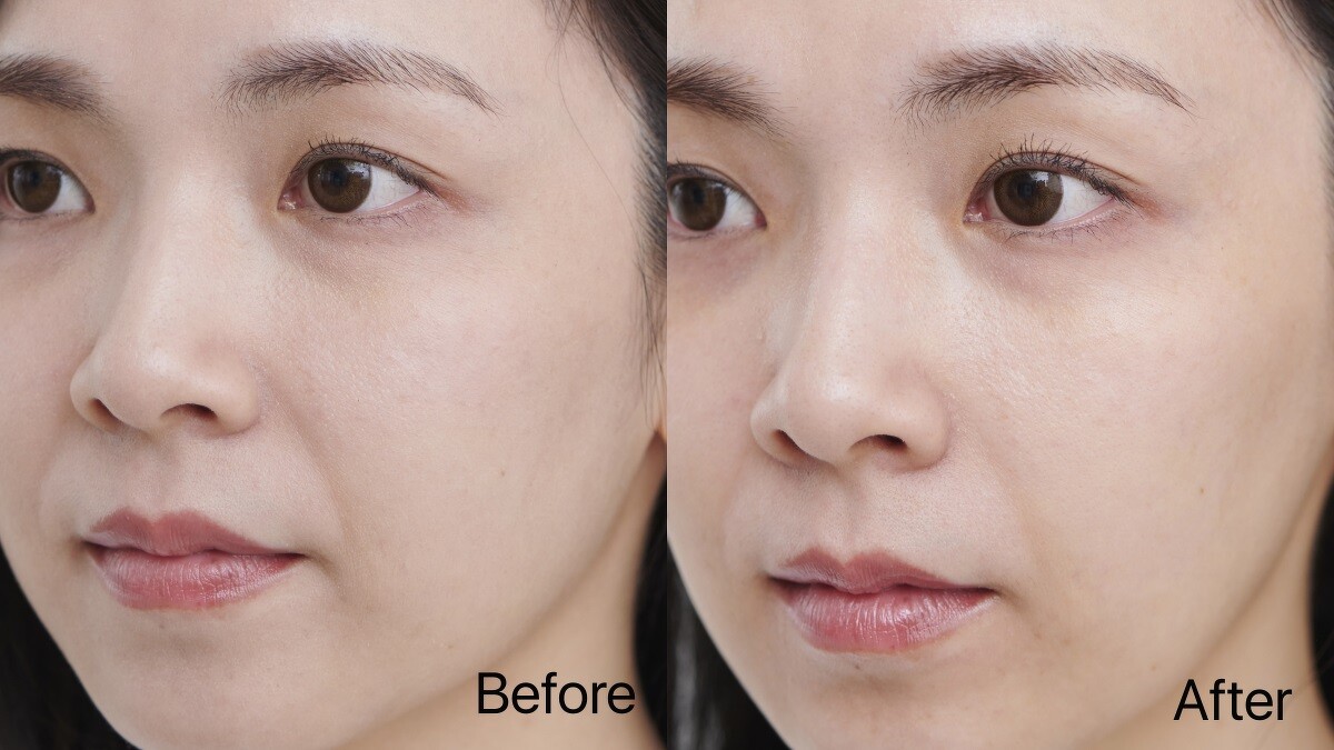 Before:雙下巴明顯，臉周鬆垮 / After:緊實上提，下巴輪廓明顯