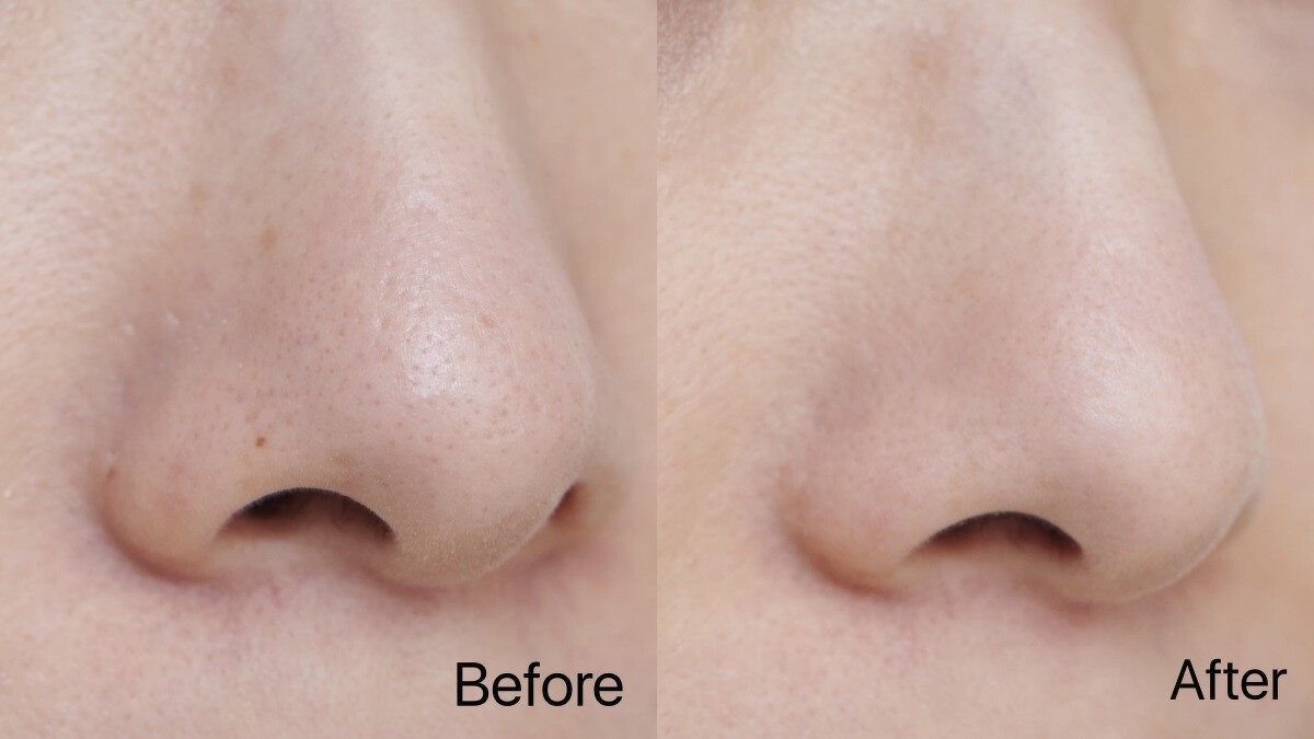 Before:毛孔粗大，粉刺爆量 / After:毛孔潔淨、細緻平滑