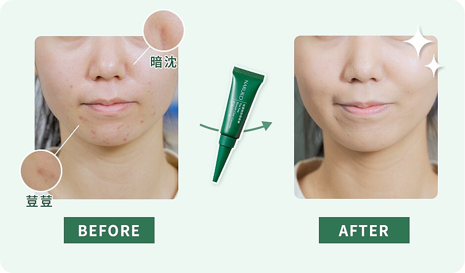 NARUKO茶樹荳荳遮瑕膏使用示意。