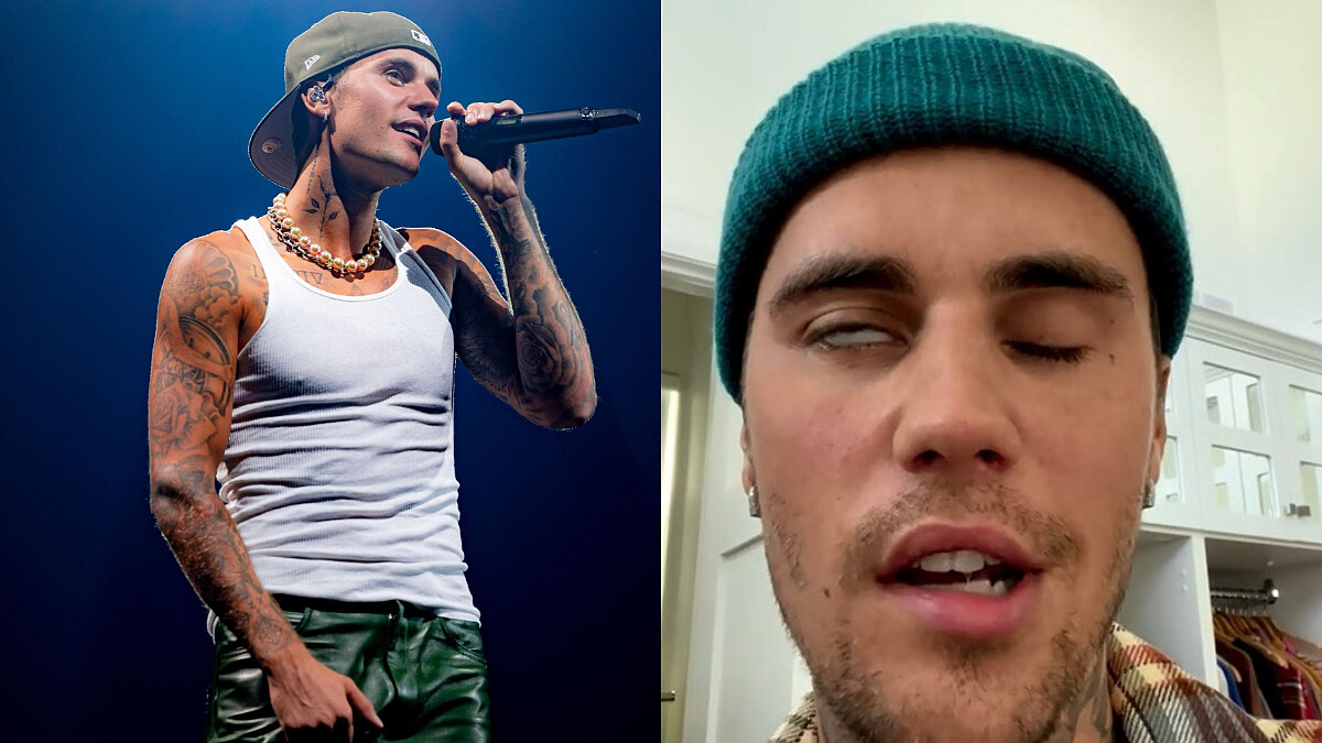 小賈斯汀Justin Bieber罹患罕見疾病面癱！曝右臉不能動，什麼是侖謝亨特氏症候群？