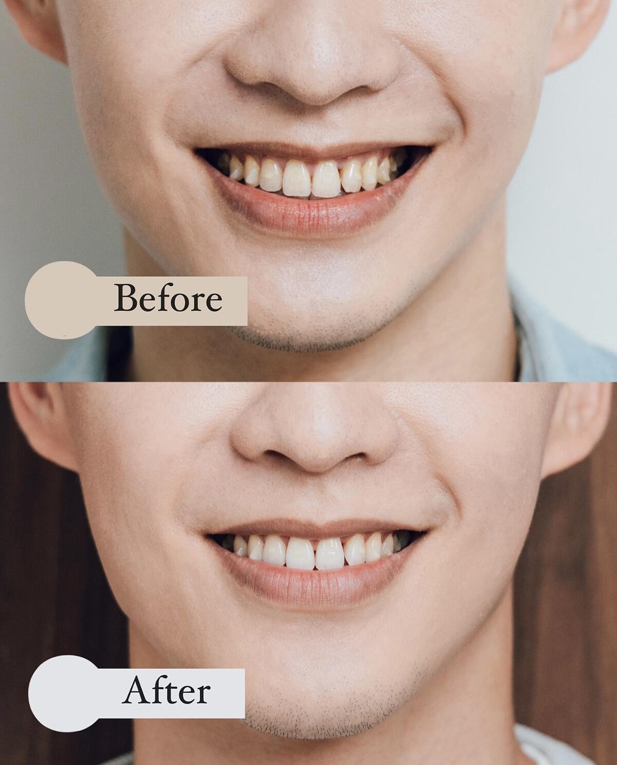 飛利浦Sonicare音波牙刷，使用前vs.使用後，以「音波流體潔力」有效去除牙菌斑和牙漬，深入清潔一般手動牙刷/旋轉式電動牙刷清不到的地方，預防蛀牙和牙結石，一週亮白兩色階。圖／牙醫師炫晨提供