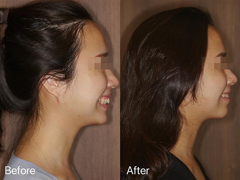 醫師分享隱形牙套除了讓牙齒變得美觀之外，良好的咬合還能修正臉型，讓下巴線條更明顯，整個人看起來更有精神