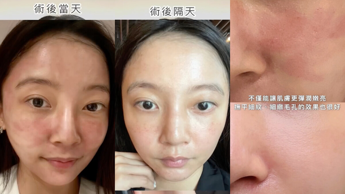 左圖上可見科學美容當天肌膚大範圍泛紅；右邊的肌膚擦上小黑瓶PRO後泛紅面積減少，且膚況更細緻。圖片來源@dolly617wa 