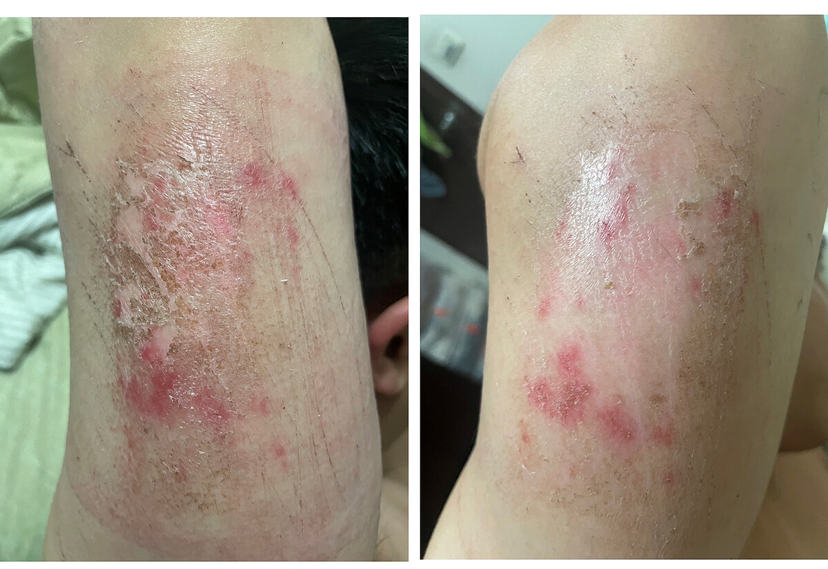 左 : 手臂擦傷未使用＃28膠原霜前，右 : 手臂擦傷使用＃28膠原霜後