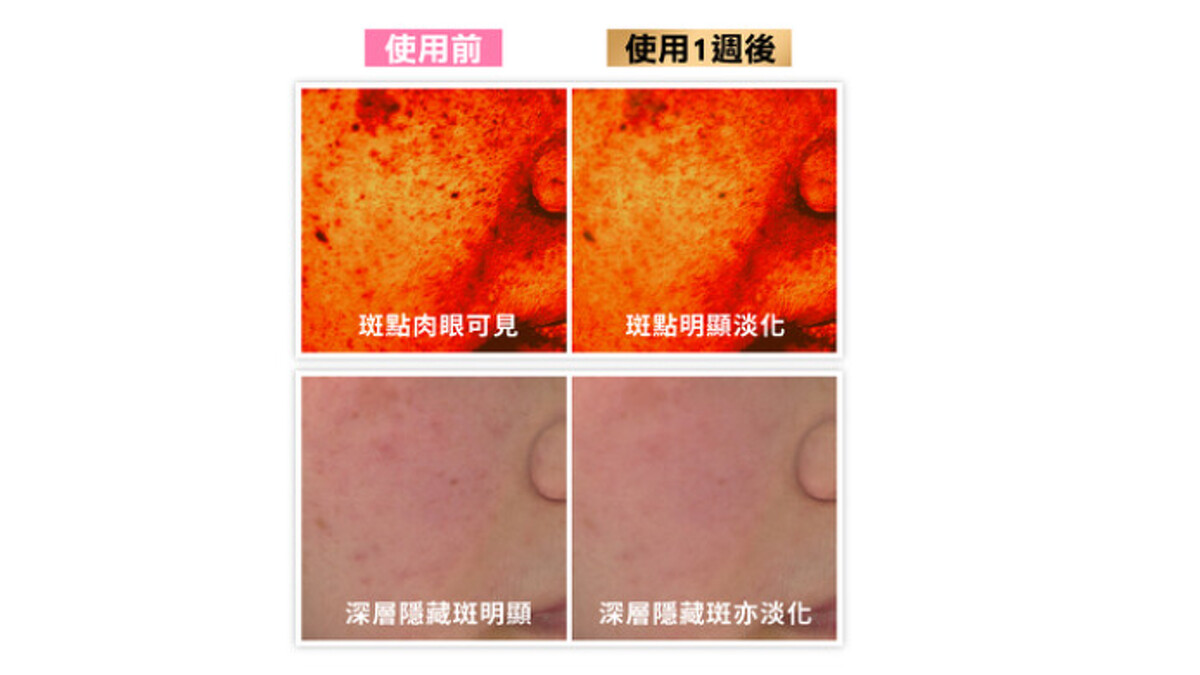 皮膚科醫師親測!五大類型表層斑點、深層隱藏斑點都能通通KO!