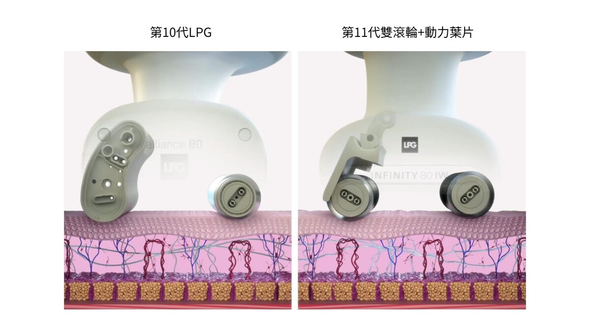 第11代LPG『無限&infin;』智能探頭升級為雙滾輪+葉片設計