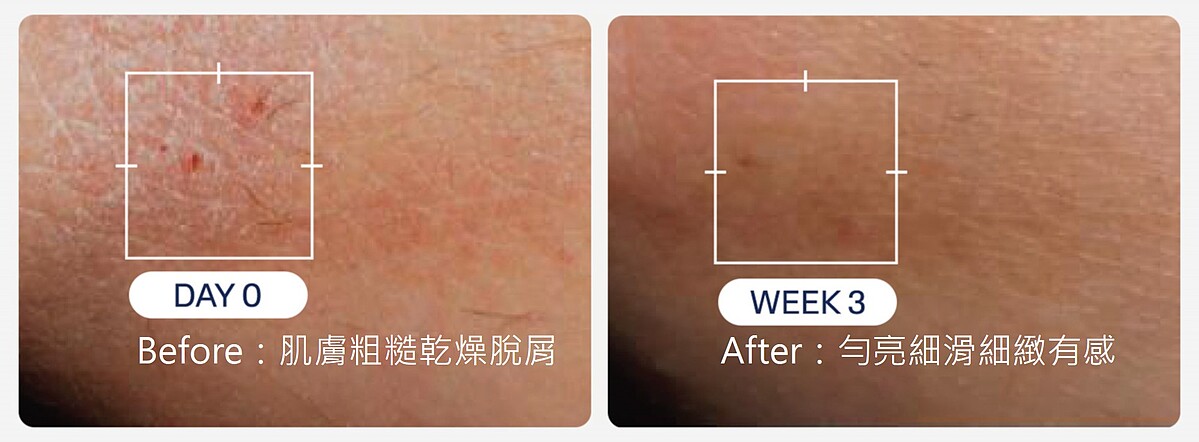 临床实证：100%降低乾燥脱屑**，三週重现健康肌肤***