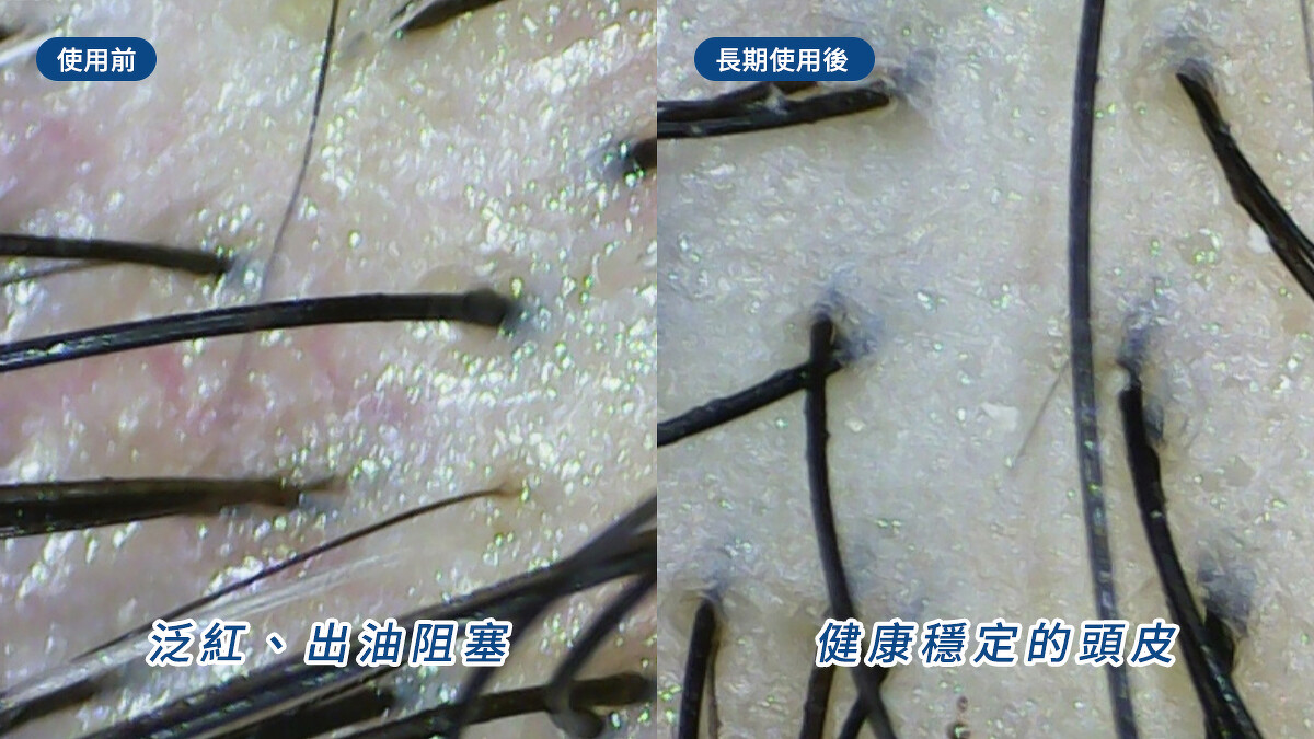 使用海倫仙度絲「頭皮護理洗髮露玫瑰蓬鬆款」後的在頭皮檢測儀下放大,明顯變得潔淨、健康!